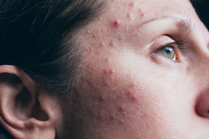 SOS acne e trattamenti estetici: Martina Fichera vi dice cosa fare